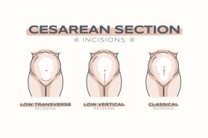 Illustration showing types of caesarean section incisions, supporting understanding of standardised perinatal care and clinical practice.